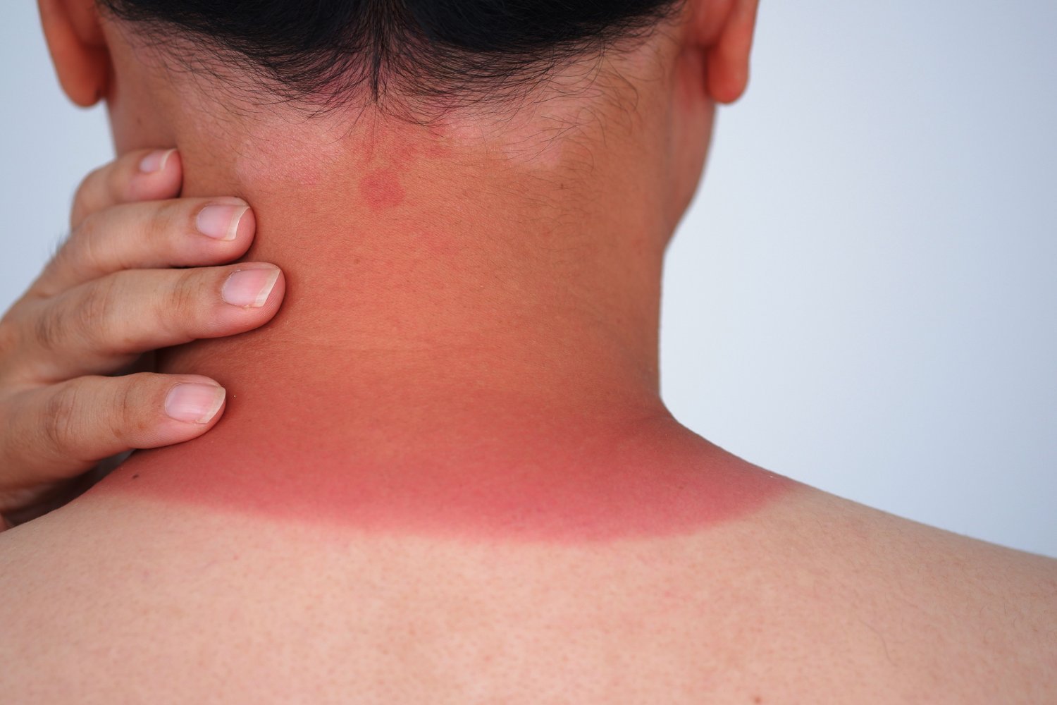 A man with a sunburn on his neck.